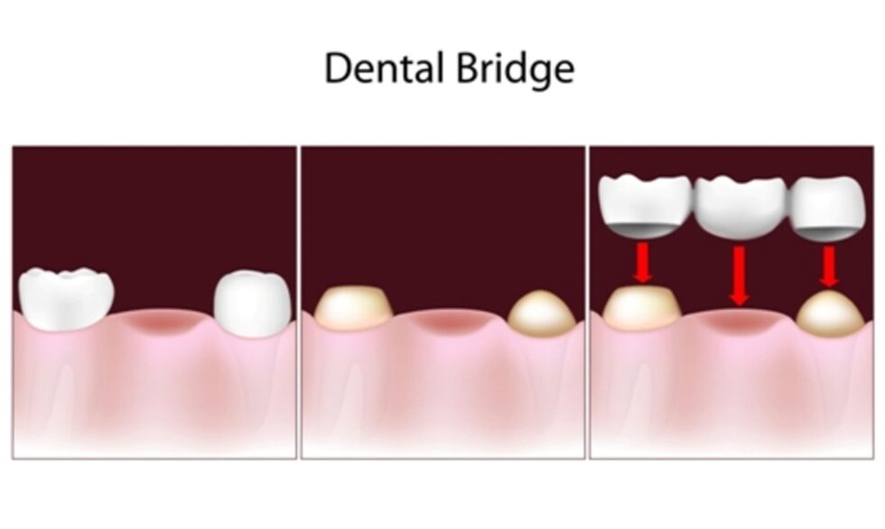 Dental Bridges Are A Solution For Missing Teeth