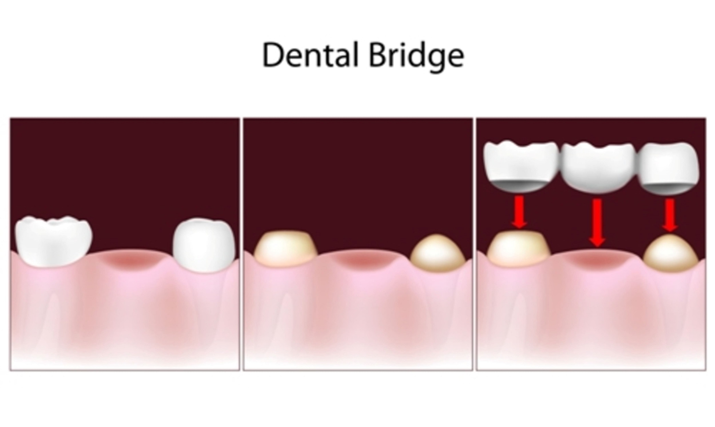 Dental Bridges Are a Solution for Missing Teeth