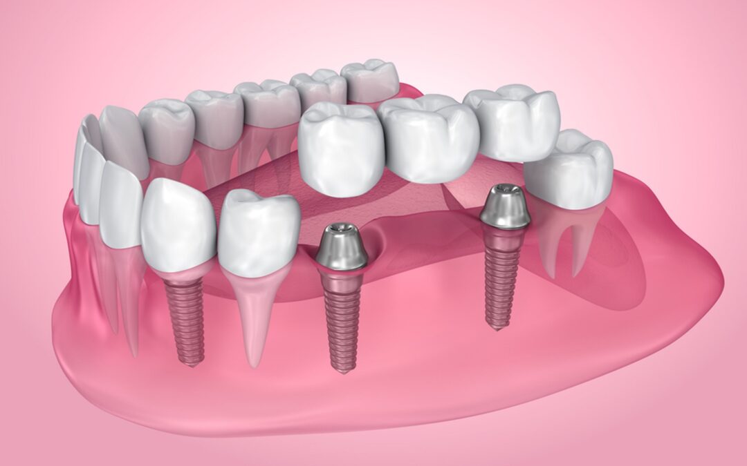 How Long Do Dental Bridges Last?