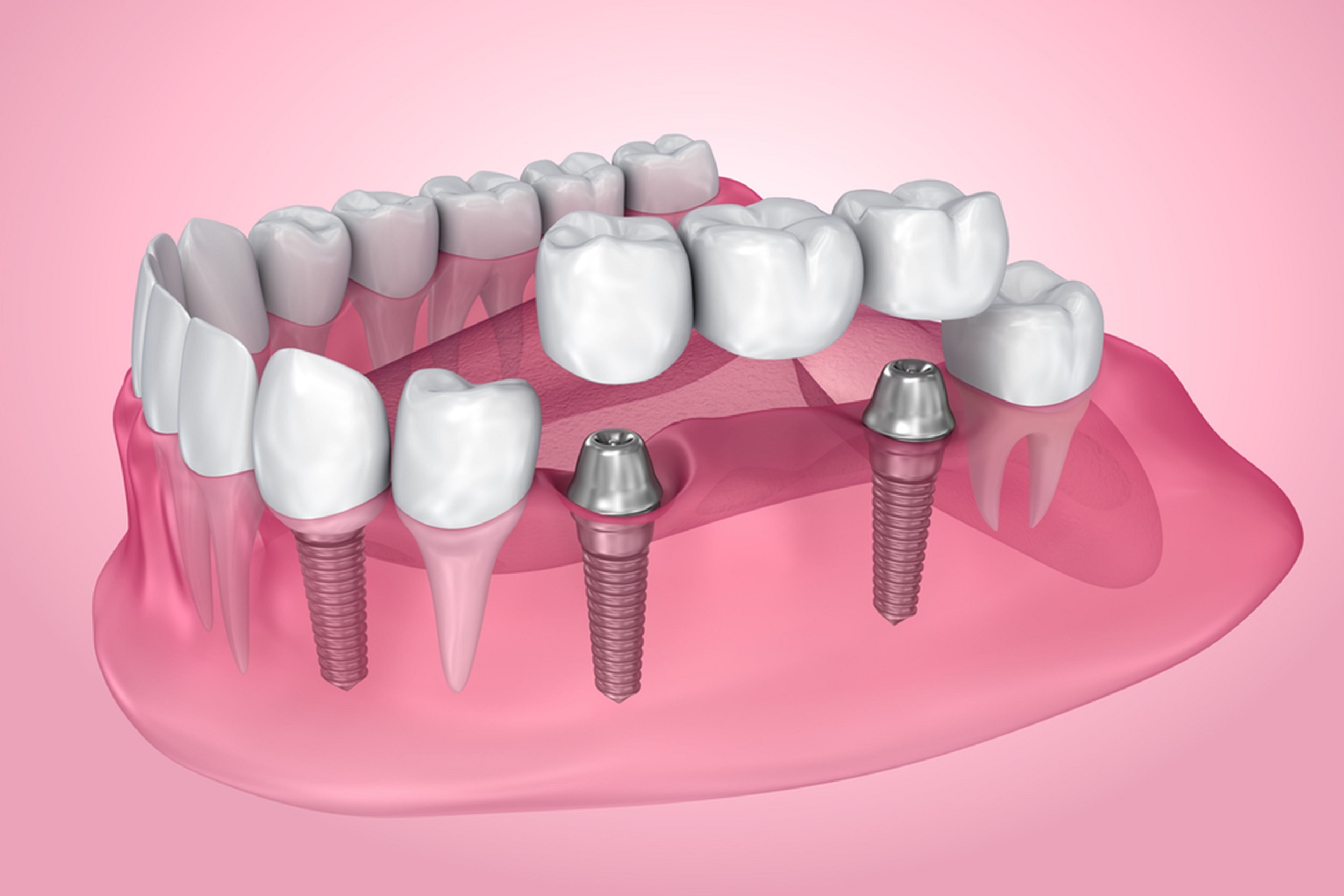 how-long-do-dental-bridges-last