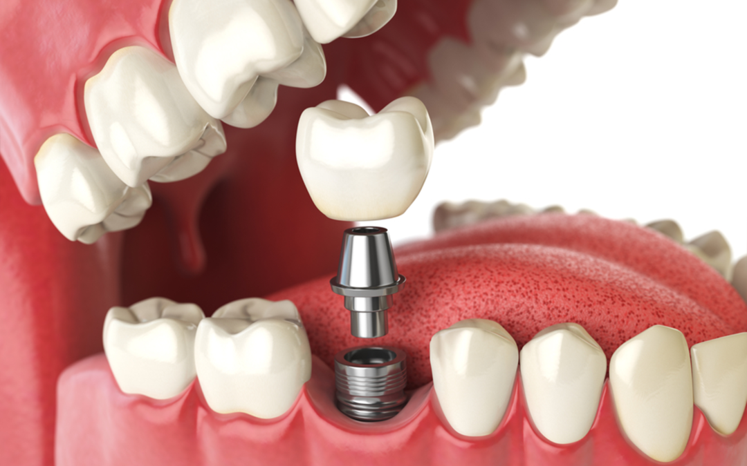 Five Facts You Probably Didn’t Know About Dental Implants