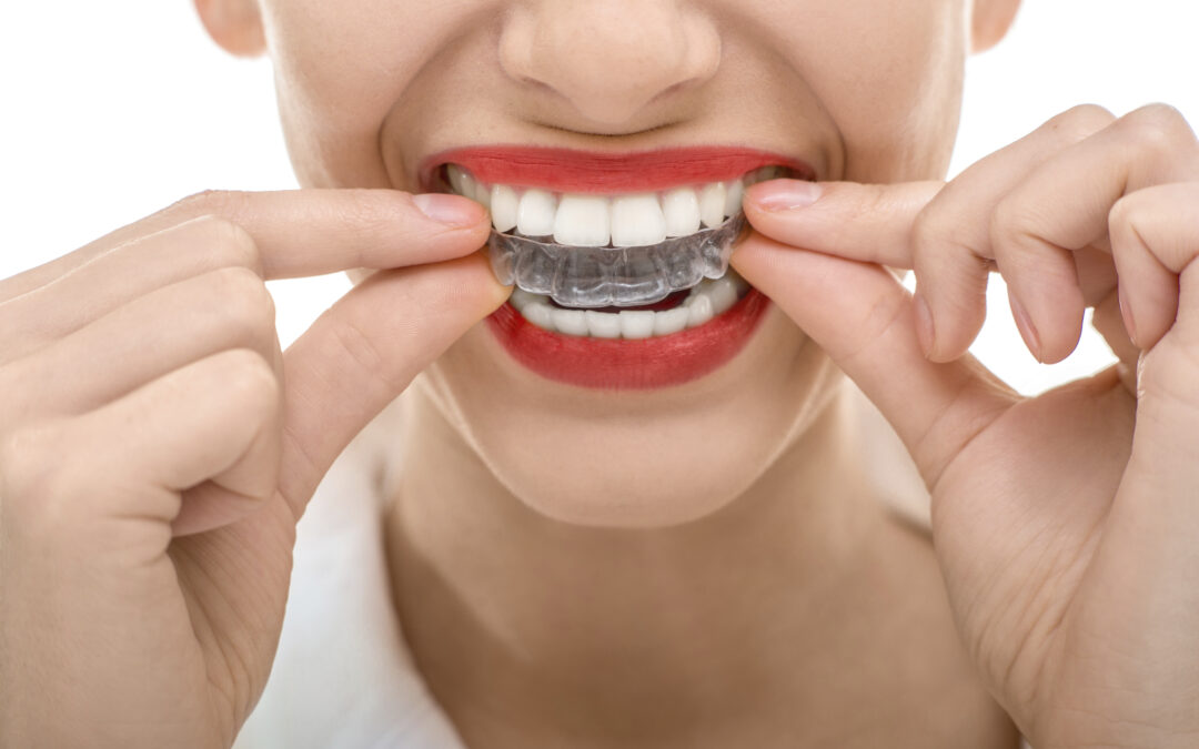 All of Invisalign’s Advantages in Six Words