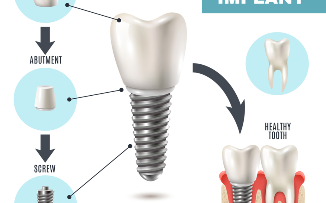 dental implants in Wainwright